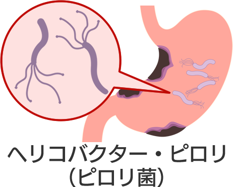 胃がんの発生要因（長津田厚生総合病院・消化器内科）
